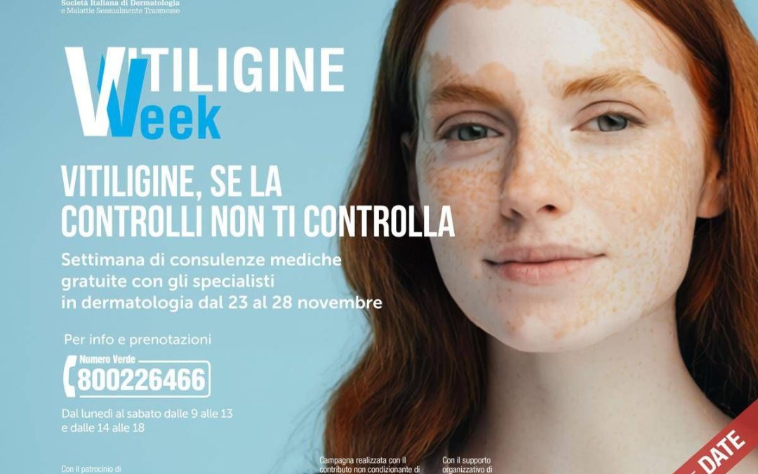 Vitiligine week, Sidemast: “Circa mille consulenze dermatologiche gratuite”